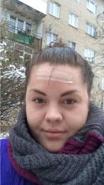Плазмолифтинг фото
