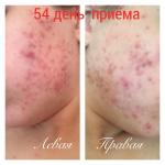 Капсулы для лечения угревой болезни Jadran "Акнекутан" фото