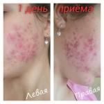 Капсулы для лечения угревой болезни Jadran "Акнекутан" фото