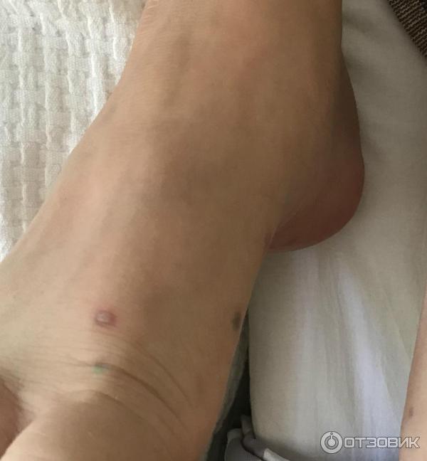 Лосьон Овадрил фото