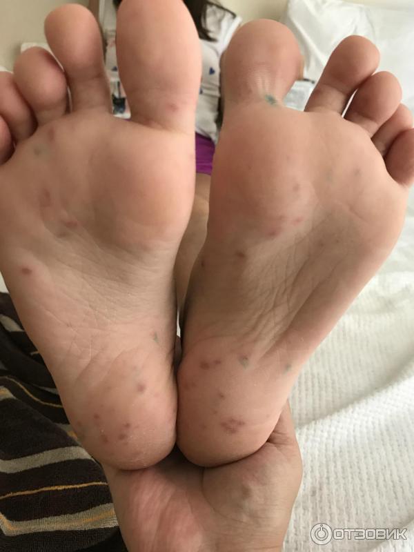 Лосьон Овадрил фото