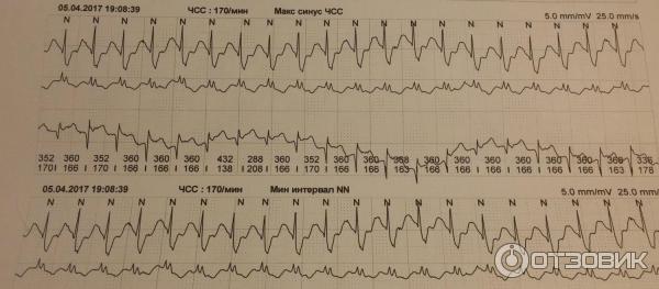 Суточный (Холтеровский) мониторинг ЭКГ фото