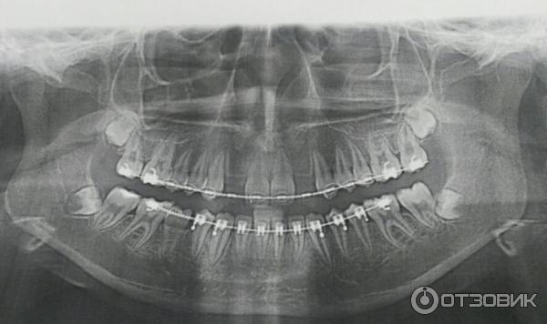 Имплантат Nobel Biocare фото