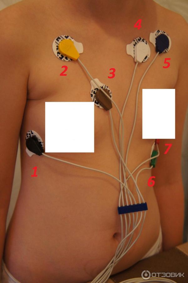 Датчик холтера установка. Холтер Валента электроды. Холтер электроды расположение электродов. Наложение электродов Холтер ЭКГ Валента. Холтеровское мониторирование 10 электродов.