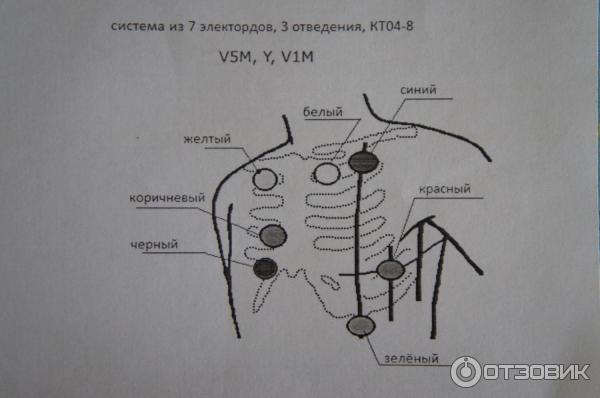 Датчики холтера схема. Схема установки электродов при холтеровском мониторировании. Наложение электродов монитора. Мониторинг ЭКГ наложение электродов. Миокард Холтер наложение электродов.