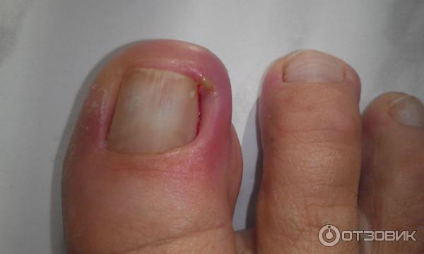 Скрученные ногти: причины и методы лечения